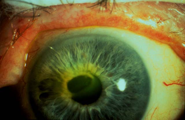 herpes zoster ophthalmicus cornea